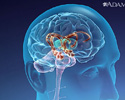 Alzheimer disease - Animation
                    