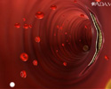 Atherosclerosis - Animation
                    