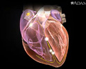 Arrhythmias - Animation
                    