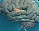 Athetosis resulting from basal ganglia injury - Animation
                    