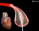 Balloon angioplasty - short segment - Animation
                    