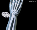 Bone fracture repair - Animation
                    