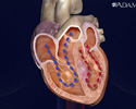 Cardiomyopathy - Animation
                    