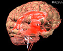 Cerebral aneurysm - Animation
                    