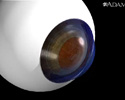 Corneal injury - Animation
                    