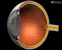 Diabetes - condiciones retinales - Animación
                    