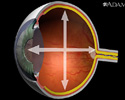 Glaucoma - Animación
                    