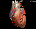 Cirugía de derivación cardiaca - Animación
                    