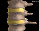 Herniated nucleus pulposus (slipped disk) - Animation
                    