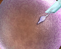 Intracytoplasmic sperm injection - Animation
                    