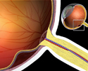 Desprendimiento de retina - Animación
                    