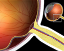 Retinal detachment - Animation
                    