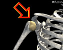 Shoulder joint dislocation - Animation
                    