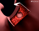 Stomach ulcer - Animation
                    