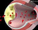 Accidente cerebrovascular - Animación
                    