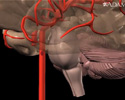 Derrame cerebral - secundario a la embolia cardiogénica - Animación
                    