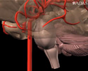 Stroke - secondary to cardiogenic embolism - Animation
                    