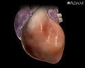 Tachycardia - Animation
                    
