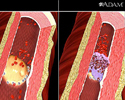 Tobacco use - effects on arteries - Video
                                      