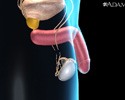 Vasectomy - Animation
                    