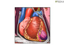 Enfermedad de la arteria coronaria - Animación
                    