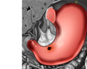 Úlcera estomacal - Animación
                    