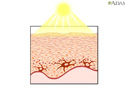 Sun's effect on skin - Animation
                    
