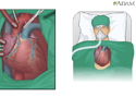 Injerto de derivación de la arteria coronaria  - Animación
                    