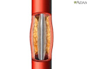 Percutaneous transluminal coronary angioplasty (PTCA) - Animation
                    