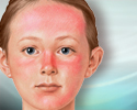 How to treat a sunburn - Animation
                    