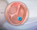 Ear tube insertion - Animation
                    