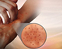 Atopic dermatitis - Animation
                    