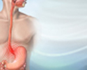 Gastroesophageal reflux disease - Animation
                    