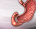 Peptic ulcer - Animation
                    