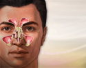 Sinusitis - Animation
                    