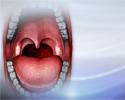 Strep throat - Animation
                    