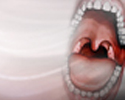 Tonsillitis - Animation
                    