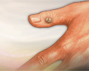 Warts - Animation
                    