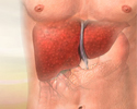 Alcoholic liver disease - Animation
                    