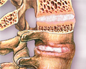 Ankylosing spondylitis - Animation
                    