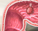 Colorectal polyps - Animation
                    