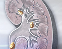 Kidney stones - Animation
                    
