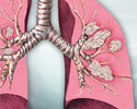 Lung cancer - Animation
                    