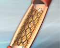 Stent - Animation
                    