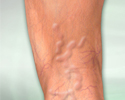 Varicose veins - Animation
                    