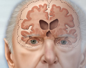 Alzheimer disease - Animation
                    