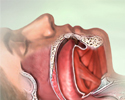 Obstructive sleep apnea - Animation
                    