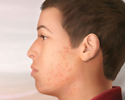 Acne - Animation
                    