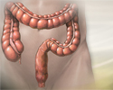 Irritable bowel syndrome - Animation
                    