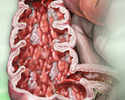 Crohn disease - Animation
                    